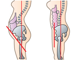 骨盤矯正